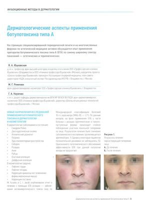 В журнале «Инъекционная косметология» 1/2016 г. опубликована статья  «Дерматологические аспекты применения ботулотоксина типа А»