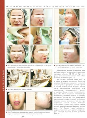 В журнале "Экспериментальная и клиническая дерматокосметология" №1 2013г. опубликована статья "Мускулистый тип старения: выбор техники объемного моделирования лица"