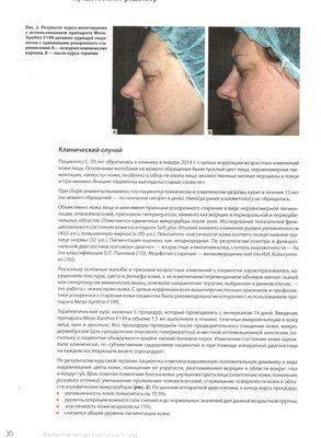 Журнал «Инъекционные методы в косметологии» №2 2014 г. опубликовал статью «Клинический случай: мезотерапия синдрома «кожа курильщика» с применением препарата Meso-Xanthin F199»