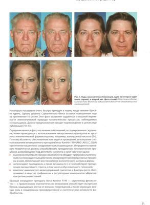 Журнал «Инъекционные методы в косметологии» №2 2014 г. опубликовал статью «Клинический случай: мезотерапия синдрома «кожа курильщика» с применением препарата Meso-Xanthin F199»