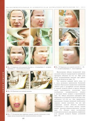 В журнале "Экспериментальная и клиническая дерматокосметология" №1 2013г. опубликована статья "Мускулистый тип старения: выбор техники объемного моделирования лица"